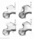 Fig. 07 - Load dissipating arthoplasty prostheses