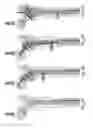 Fig. 09 - Load dissipating arthoplasty prostheses