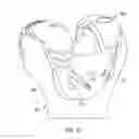 Fig. 45 - Revision knee arthroplasty methods and instruments