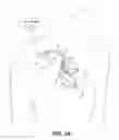 Fig. 03 - Bundle branch pacing devices and methods