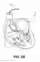 Fig. 04 - Bundle branch pacing devices and methods