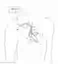 Fig. 01 - Leadless pacing device for His bundle and bundle branch pacing