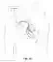 Fig. 03 - Leadless pacing device for His bundle and bundle branch pacing