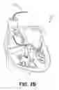 Fig. 04 - Leadless pacing device for His bundle and bundle branch pacing