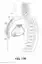 Fig. 20 - Leadless pacing device for His bundle and bundle branch pacing