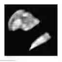 Fig. 01 - Patient pre-positioning in frameless cranial radiosurgery using thermal imaging