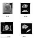 Fig. 03 - Patient pre-positioning in frameless cranial radiosurgery using thermal imaging