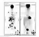 Fig. 01 - Radiotherapy targeted to promote a systemic abscopal effect
