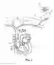Fig. 02 - Direct visualization catheter and system