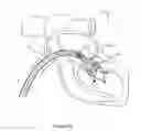 Fig. 09 - Heart valve prosthesis and method
