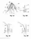 Fig. 03 - Inferior vena cava filter with stability features
