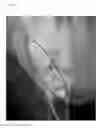 Fig. 19 - Device for tendon and ligament reconstruction