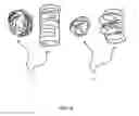 Fig. 08 - Adjustable self-locking papillary muscle band