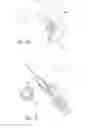 Fig. 07 - Implantation of micronized allograft tissue over a microfractured defect