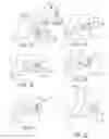 Fig. 09 - Implantation of micronized allograft tissue over a microfractured defect