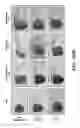 Fig. 33 - Methods for treatment of melanoma