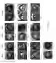 Fig. 08 - Compositions And Methods To Treat And/Or Prevent Vision Disorders Of The Lens Of The Eye