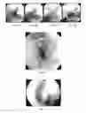 Fig. 10 - Implantable scaffolds for treatment of sinusitis
