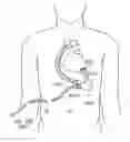 Fig. 01 - METHOD OF ATTACHING TISSUE SUBSTITUTE ARTIFICIAL FIBER CLOTH, CONNECTING CABLE FOR AUXILIARY ARTIFICIAL HEART, AND AUXILIARY ARTIFICIAL HEART SYSTEM