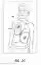 Fig. 05 - Universal defibrillation electrode pad assembly for adult and pediatric subjects