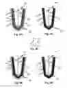 Fig. 06 - Filter devices methods and system