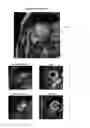 Fig. 01 - Left ventricle segmentation in contrast-enhanced cine MRI datasets