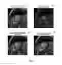 Fig. 08 - Left ventricle segmentation in contrast-enhanced cine MRI datasets