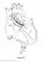 Fig. 23 - Heart valve prosthesis and method