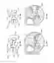 Fig. 49 - Configurable Intervertebral Implant
