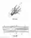 Fig. 08 - DEVICES AND METHODS FOR PERCUTANEOUS TISSUE REMOVAL