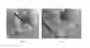Fig. 09 - Apparatus and methods for resecting and/or ablating an undesired tissue
