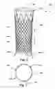 Fig. 07 - Intraluminal device and method of fixation