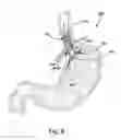 Fig. 09 - Intraluminal device and method of fixation