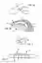 Fig. 02 - DEVICES, SYSTEMS AND METHODS FOR TREATING BENIGN PROSTATIC HYPERPLASIA AND OTHER CONDITIONS