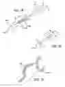 Fig. 05 - DEVICES, SYSTEMS AND METHODS FOR TREATING BENIGN PROSTATIC HYPERPLASIA AND OTHER CONDITIONS