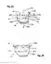 Fig. 04 - Two component mitral valve