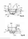 Fig. 07 - Two component mitral valve