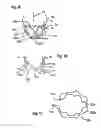 Fig. 08 - Two component mitral valve