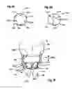 Fig. 10 - Two component mitral valve