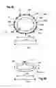 Fig. 15 - Two component mitral valve