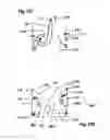 Fig. 19 - Two component mitral valve