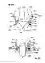 Fig. 30 - Two component mitral valve