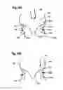 Fig. 31 - Two component mitral valve
