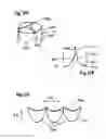 Fig. 32 - Two component mitral valve