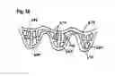Fig. 35 - Two component mitral valve