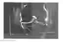 Fig. 01 - Osteoarthritis treatment and device
