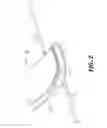 Fig. 08 - PROSTHETIC FOOT WITH SPACED SPRING ELEMENTS