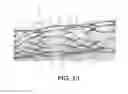 Fig. 15 - BIDIRECTIONAL STENT AND METHOD OF USE THEREOF