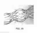 Fig. 17 - BIDIRECTIONAL STENT AND METHOD OF USE THEREOF
