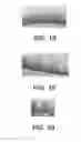 Fig. 20 - BIDIRECTIONAL STENT AND METHOD OF USE THEREOF